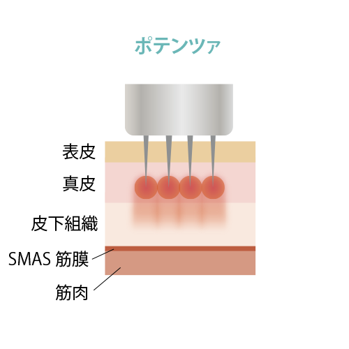 ポテンツァ適用時の皮膚断面模式図