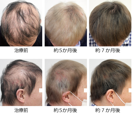 最安値在庫 ヘアフィラー 薄毛・養毛・育毛・白髪・2セット入り2回分