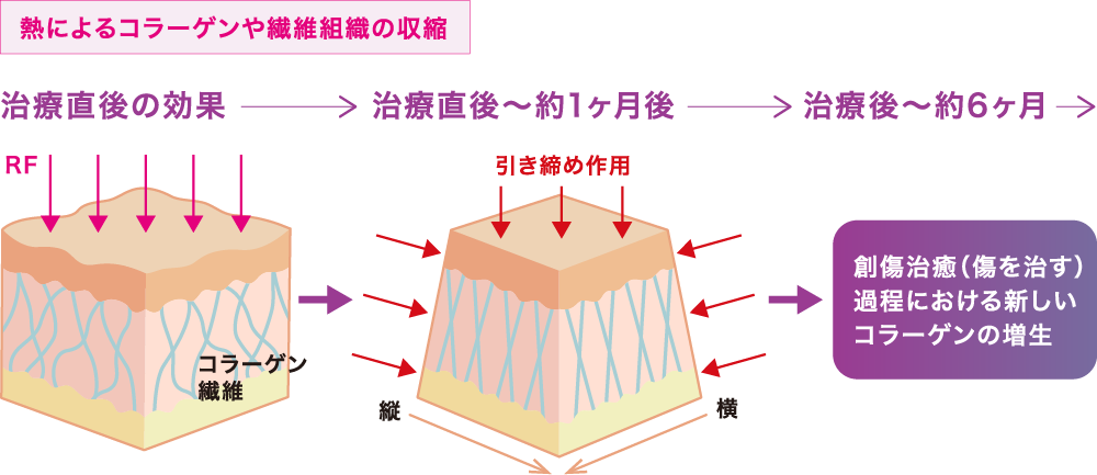 表面的な引き締めに加え、お肌奥までの引き締め・引き上げ効果もあります