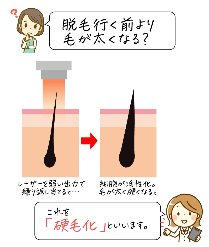 硬毛化って？顔の毛が脱毛行く前より太くなる⁉