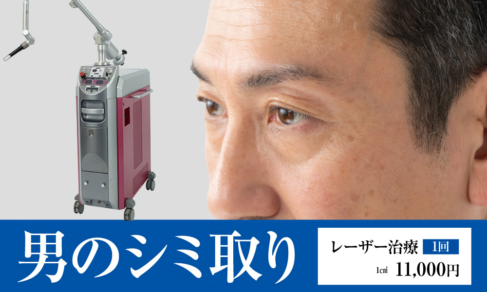 男のシミ取り
