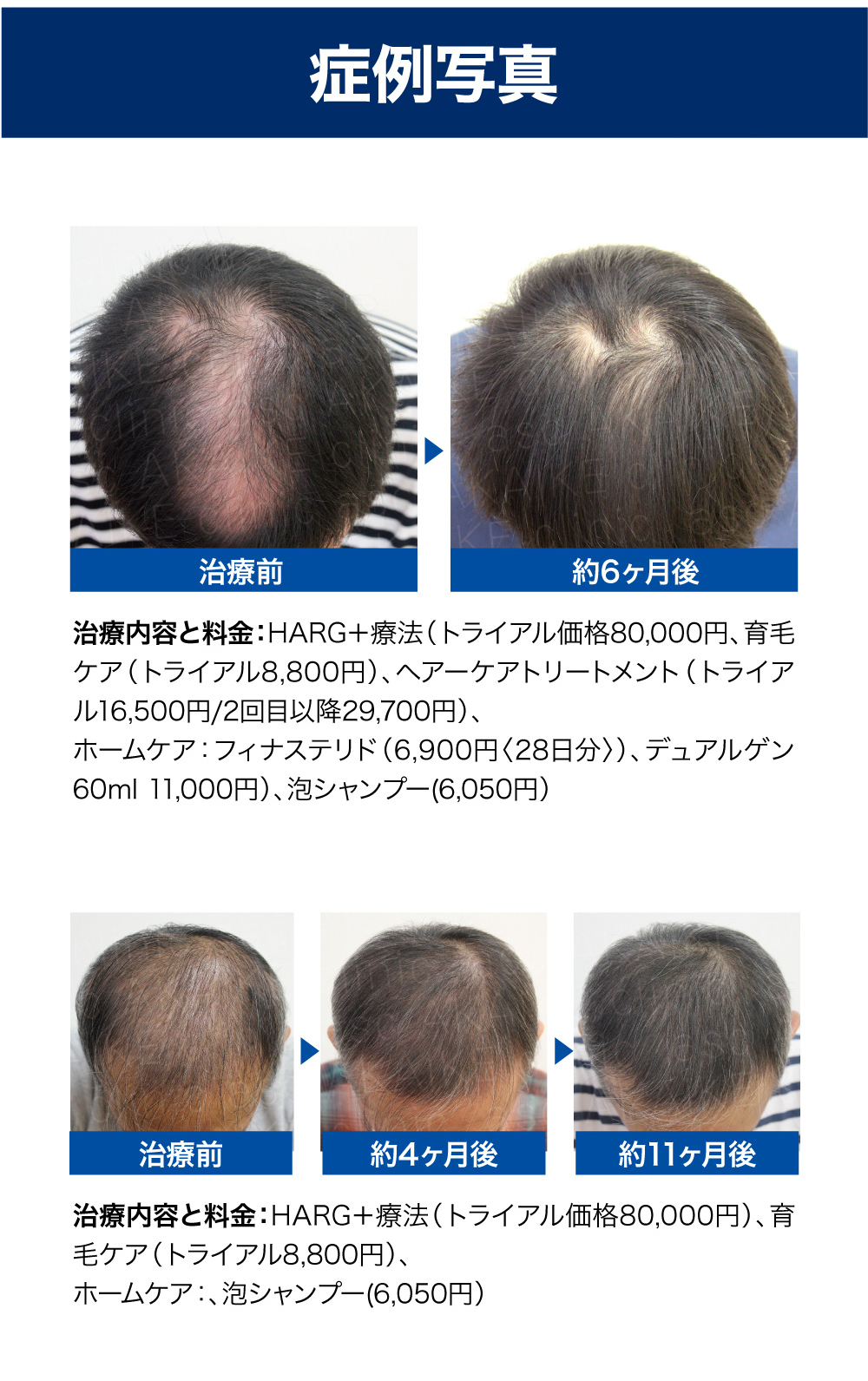 赤池クリニックの男性AGA・薄毛治療の症例写真｜HARG+療法と育毛ケアの治療前後