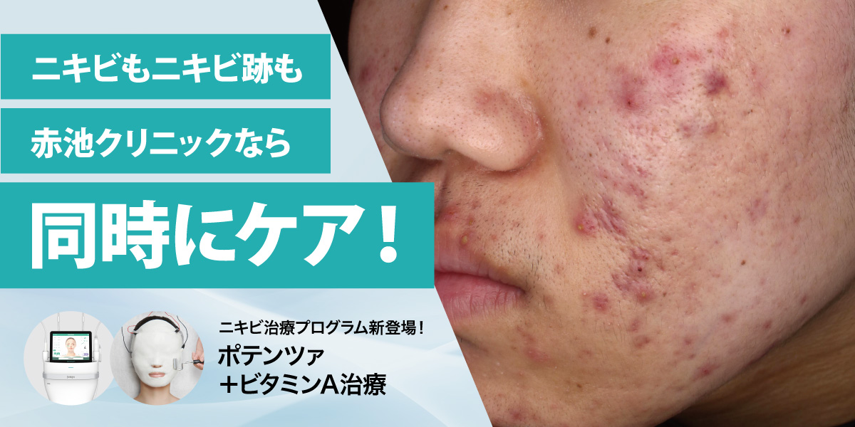 男性のニキビ・ニキビ跡・毛穴治療